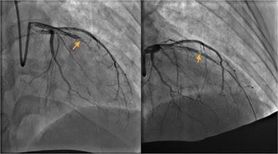 Perioperative management of acute myocardial infarction in the 31st week of pregnancy: A case report and literature review